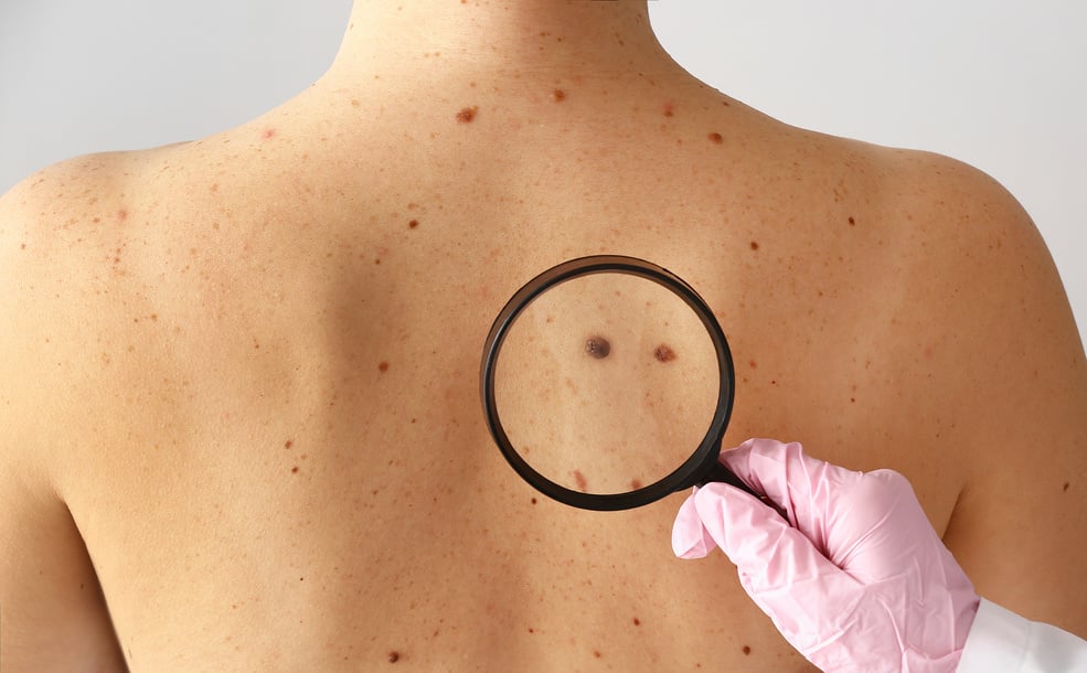 Dermatologist Examining Moles of Patient in Clinic